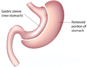 Gastric sleeve image showing gastric sleeve (new stomach) on left and removed portion of stomach on right