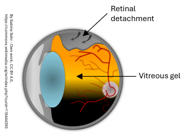 Retinal detachment image.png