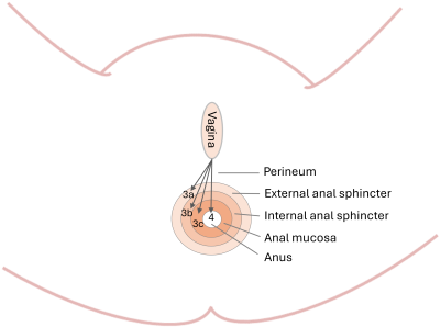 Perineal 3rd 4th tear diagram.png