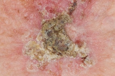 Actinic keratosis picture