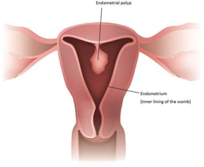 Polyp image
