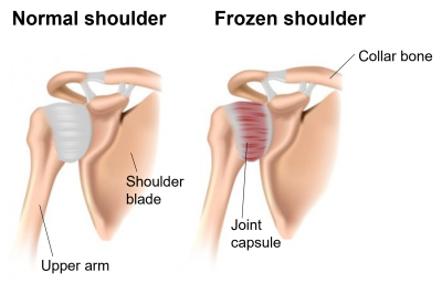 Anatomy of healthy shoulder and frozen shoulder illustration