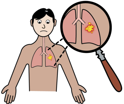 lung nodule pic.png