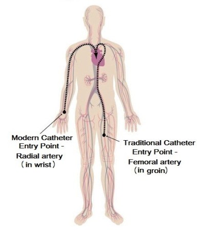 Catheter entry point image showing modern catheter entry point on left (via wrist) and traditional catheter entry point on right (via groin)